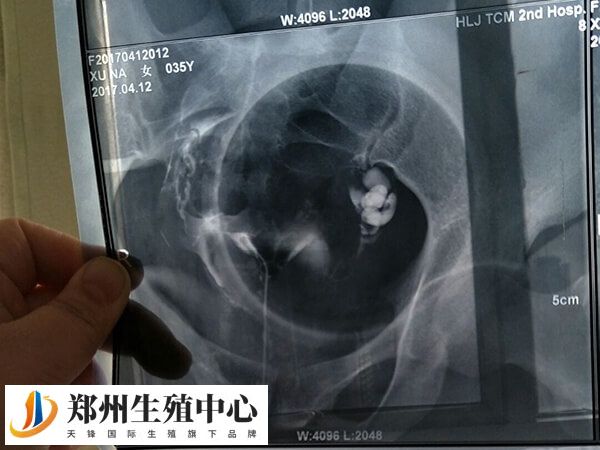 过敏性结膜炎本身并不影响试管的成功率