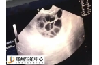 1个窦卵泡能促排出几个卵子