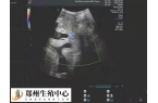 试管婴儿9周多了安不安全